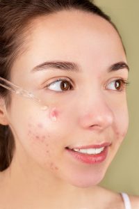 Read more about the article Acne blocked skin follicles that lead to oil, bacteria and dead skin buildup in your pores.