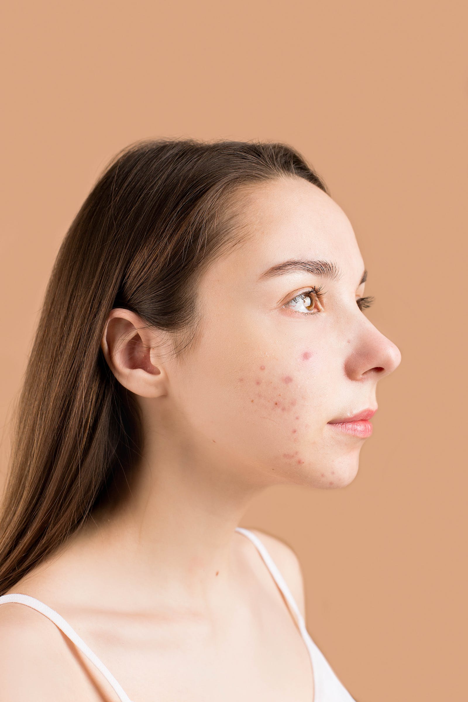 You are currently viewing Acne blocked skin follicles that lead to oil, bacteria and dead skin buildup in your pores.